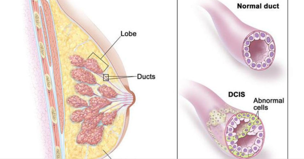 How Breast Cancer Spreads in the Chest?