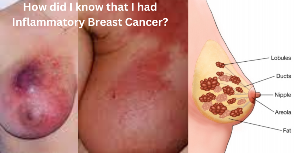 How did I know that I had Inflammatory Breast Cancer?